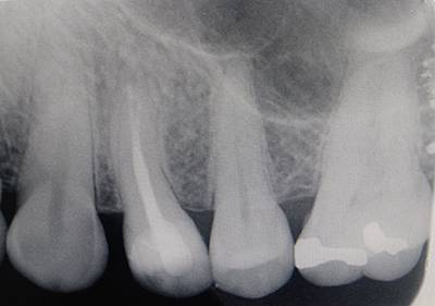 Radiografía digital de una endodoncia