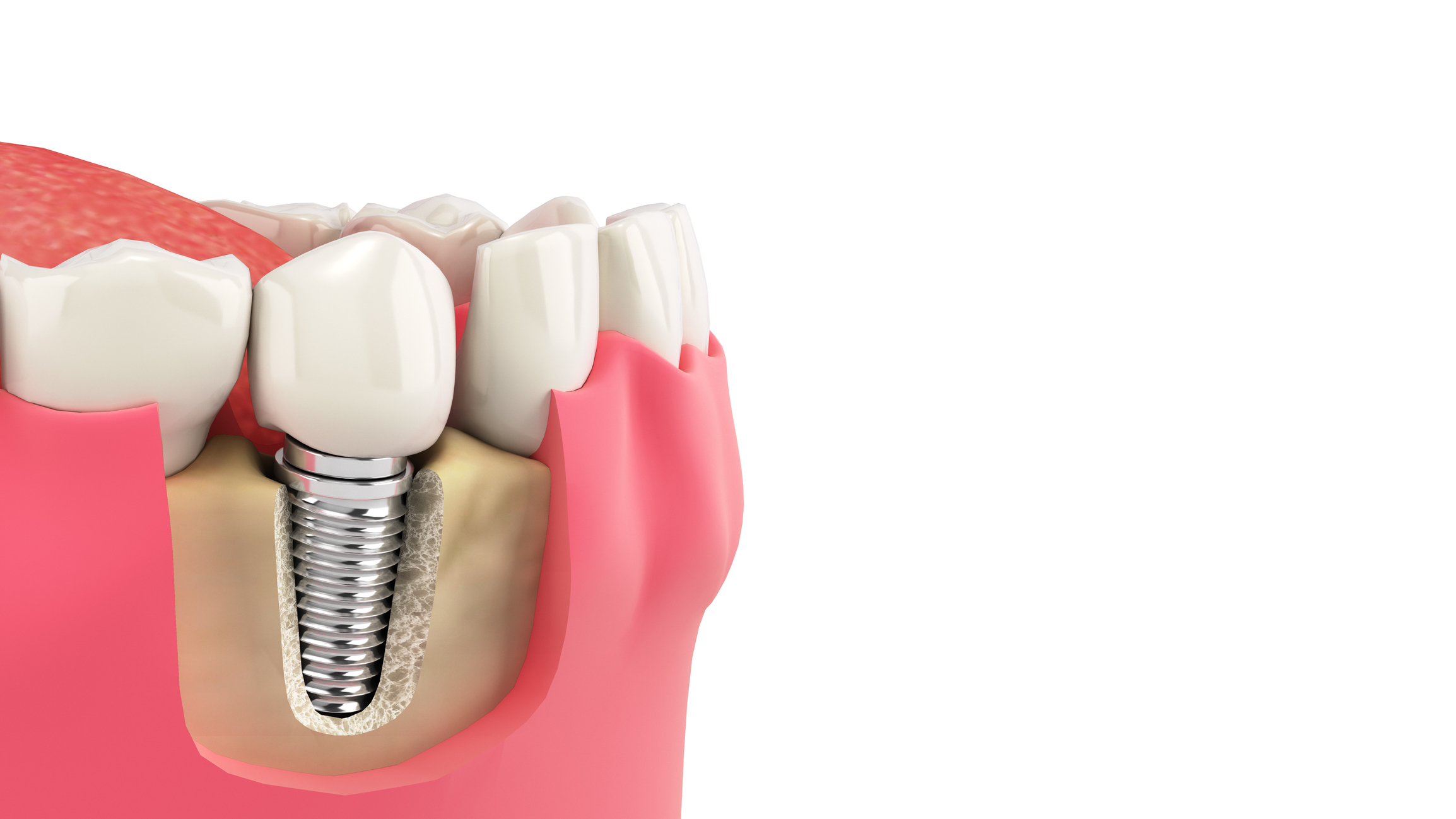 ¿Podemos colocar implantes dentales cuando hay pérdida de hueso?