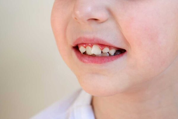 La importancia de la Ortodoncia en niños. Clínica de Ortodoncia en Albacete Belmonte