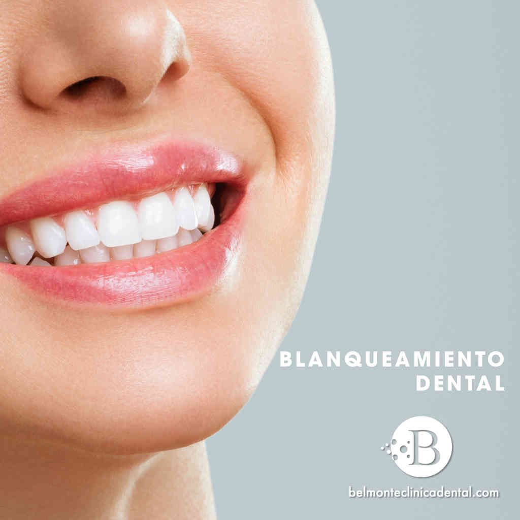 Blanqueamiento Dental: Resultados, Tipos y Cuidados